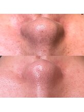 ウミ(Ummi)/毛穴エクストラクション