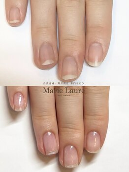 マリーロール 梅田店(Marie Laure)/自爪育成/深爪矯正/ネイルケア