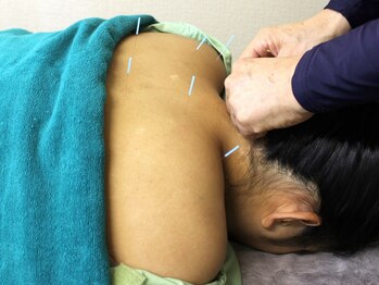 いなほ はりきゅう整骨院 東新宿/鍼灸(吸い玉併用)コース