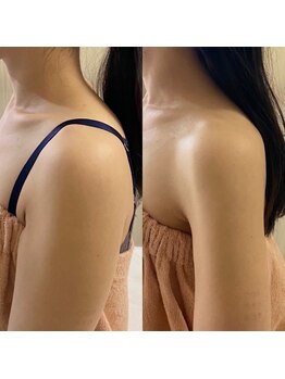 トータルビューティーサロンリア(Li'a)/二の腕引締め/脂肪分解