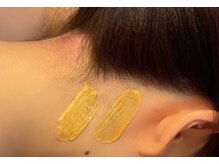 エルピス(ELPIS)/襟足/うなじMIX脱毛