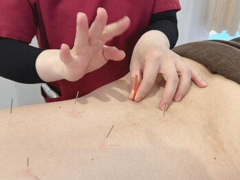 あんど整骨院 茨木院の写真/【鍼灸が初めての方にも】痛みが少ない鍼灸が大人気！不安がある方もお気軽にご相談ください♪