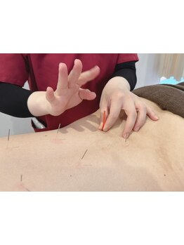 鍼灸施術を受けたい