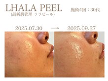 タオ(TAO)/本気の肌質改善ならララピール！