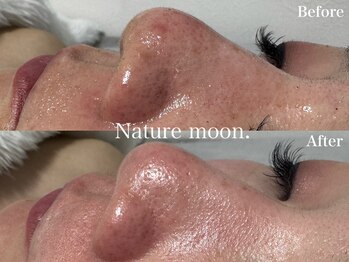 ナチュールムーン(Nature moon.)/毛穴洗浄