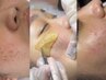 【諦めていたシミに】医療提携ホワイトラボ!一度でわかる最新シミケア¥11000
