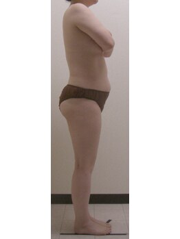 ジョイア 本店(Beauty＆Detox gioia)/松本市40代のお客様ビフォー