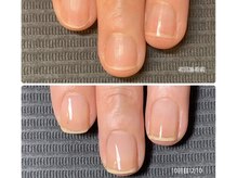 深爪・チビ爪・弱い爪のお悩み◎3ヶ月で縦長美爪に導きます！