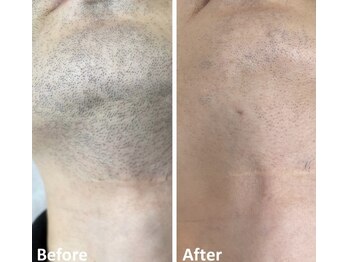 ヴィアス(vias)/メンズ髭脱毛