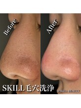 スキル アイラッシュ(SKILL eyelash)/毛穴洗浄☆黒ずみ☆くすみ