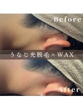 エピナ 千葉店(Epina)/うなじMIX脱毛☆