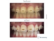 NAホワイトニング 自由が丘店/【before/after】