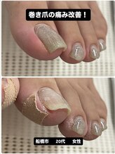 巻き爪じゅん 千葉駅前店/巻き爪の痛みを改善！