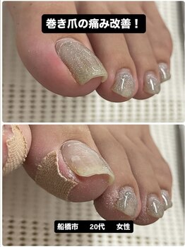 巻き爪の痛みを改善!