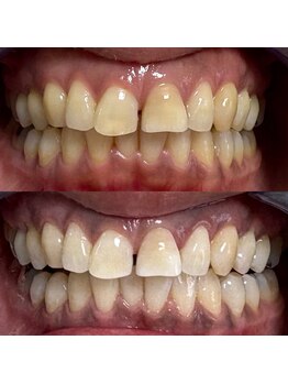 グレイスホワイトニング ヨコハマ(Grace Whitening Yokohama)/40分照射＋水素吸引