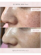 ミルフィオリ(Mille fiori)/毛穴エクストラクション