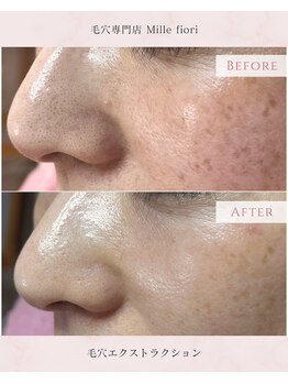 ミルフィオリ(Mille fiori)/毛穴エクストラクション