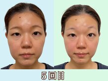 ナチュラルパーフェクトフェイス 新宿/5回目、新宿駅造顔なら当店へ