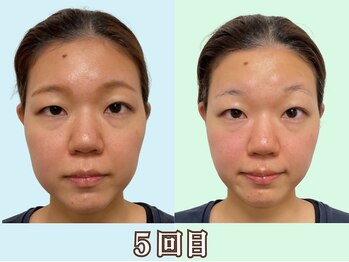 ナチュラルパーフェクトフェイス 新宿/5回目、新宿駅造顔なら当店へ