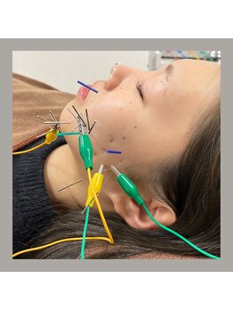 キャンディ鍼灸整骨院の写真/自律神経の乱れや疲れによる眼精疲労・頭痛を解消◎不調が出やすくなる時期に《電気美容鍼》で整える◎