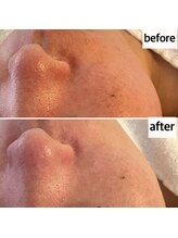 メナードフェイシャルサロン 岐阜茜部/ホワイトニングパック