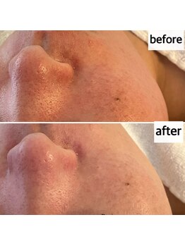 メナードフェイシャルサロン 岐阜茜部/ホワイトニングパック