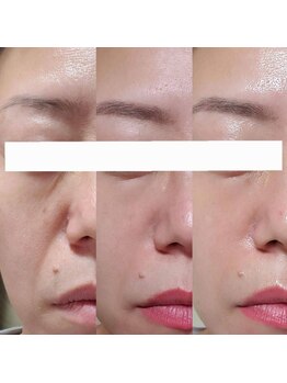 水光ピールスキン/弾力の変化が分かるピール