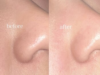 アウル 北千住本店(auL)/【フェイスワックス】鼻