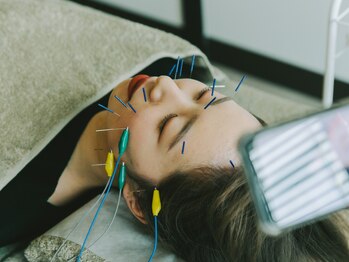 アキュネ 福岡薬院店(acune)/福岡/薬院/美容鍼/美肌