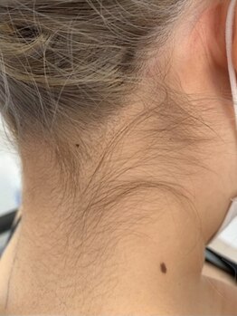 ココスターリー 筑紫野店(Coco starry)の写真/都度払い◎お手頃価格で試しやすい☆【Sパーツ脱毛¥3,500】襟足を脱毛で整えて、横顔も後ろ姿も魅力的に♪