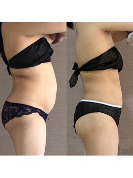 トータルビューティーサロンリア(Li'a)/ぽっこりお腹/背中の贅肉