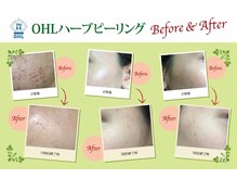 ナナラ(nanala)/OHLハーブピーリング
