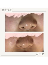 サロン ド ミコラ(salon de Micora)/次世代美容液毛穴洗浄