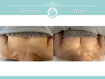 美人バスト 浜松店/◆バストアップ &nbsp;BeforeAfter◆