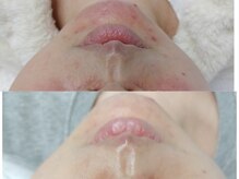 GRACETHOUSAND(グレイスサウザンド)/【韓国肌管理】ララピール