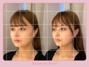 ボーテドリッシュ(Beaute de Riche)/小顔矯正beforeafter
