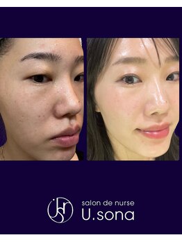 小顔・脂肪コントロール専門 salon de nurse U.sona～松本店～/【韓国基礎化粧品で肌質改善】