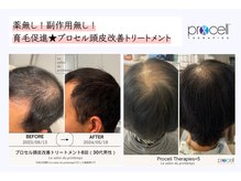 アメリカから相模原に初上陸☆頭皮改善トリートメント！