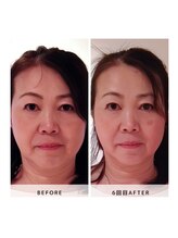 サロン レインボー(SALON RAINBOW)/小顔集中コース　Before/After