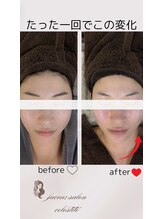 フェイシャルサロン セレスタイト/下顔面の集中ケアで小顔