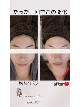 フェイシャルサロン セレスタイト/下顔面の集中ケアで小顔