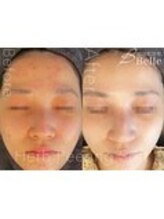 ベル 水戸(Belle)/ハーブピーリング|ニキビケア