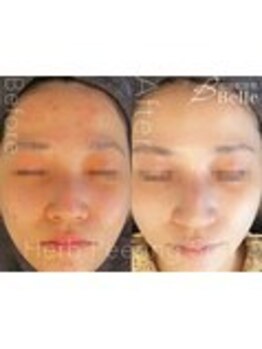 ベル 水戸(Belle)/ハーブピーリング|ニキビケア