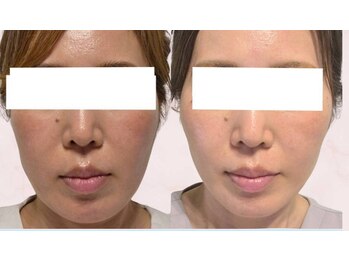 藍/顔の歪みが気になるあなたへ！