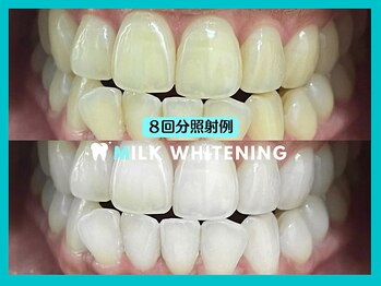 ミルクホワイトニング 新大村店(Milkホワイトニング)/★施術例