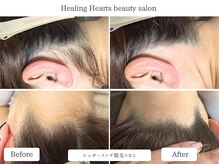 ヒーリングハーツ(Healing Hearts)の雰囲気（地域希少シュガーリング脱毛・美肌脱毛機によるムダ毛ケア♪）