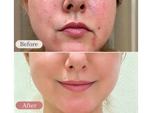 エーエフビューティーエステ(AF Beauty Esthetic)の雰囲気（ホームケア×サロントリートメントで5ヶ月の肌変化）