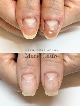 マリーロール 淀屋橋本店(Marie Laure)/自爪育成/深爪矯正/ネイルケア
