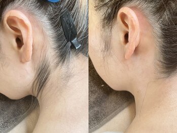 ジョワ 北堀江(joie)/大人気うなじwax 脱毛.毛穴ケア