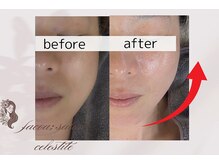 フェイシャルサロン セレスタイト/顔の輪郭、スッキリ実感